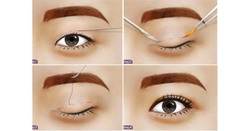 Kỹ thuật nhấn mí mắt khác hoàn toàn với cắt mí mắt