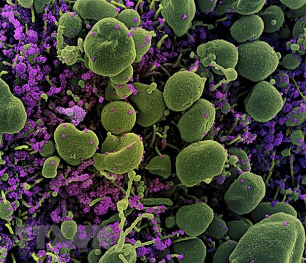 Hình ảnh dưới kính hiển vi cho thấy hình ảnh virus SARS-CoV-2 (màu tím) trong tế bào (màu xanh) của bệnh nhân COVID-19. 