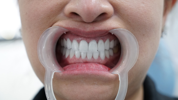 Bọc răng sứ 800K vẫn đảm bảo chất lượng nếu thực hiện tại nha khoa uy tín