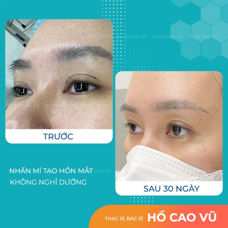 Hình ảnh khách hàng nhấn mí tạo hồn mắt do bác sĩ Hồ Cao Vũ thực hiện. Ảnh trước và sau 30 ngày tái khám