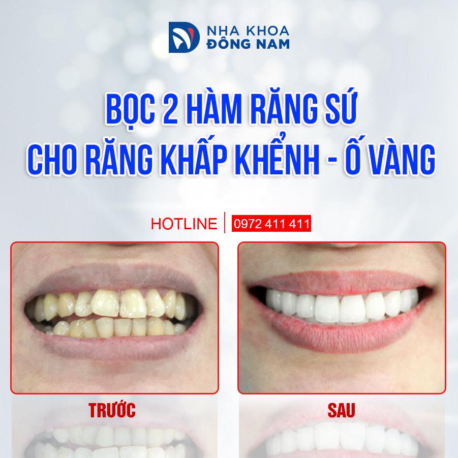 Màn “lột xác” nụ cười hoàn hảo của khách hàng sau khi bọc răng sứ