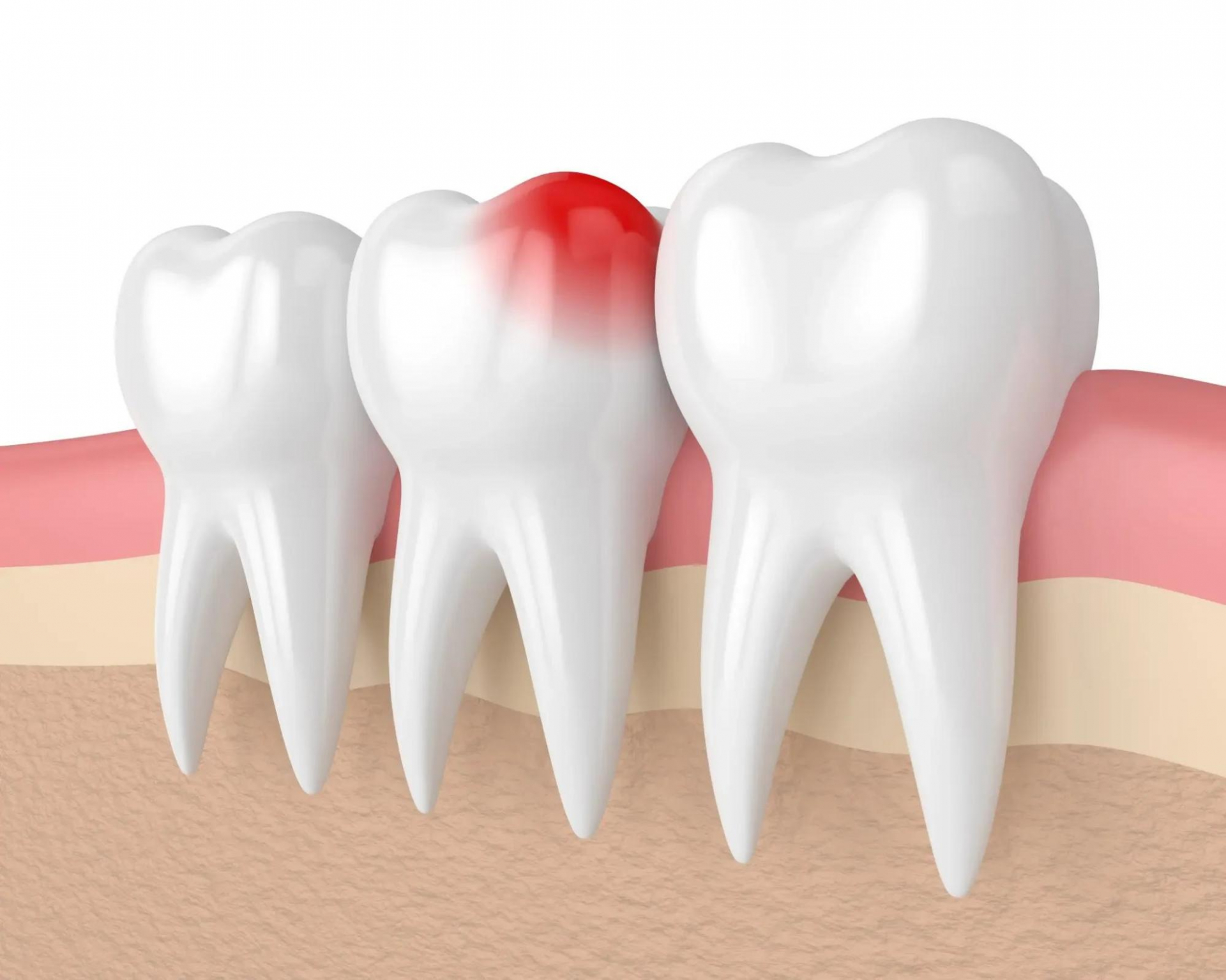 Chi phí nhổ răng khôn sẽ khác biệt tuỳ vào độ phức tạp của răng cần loại bỏ