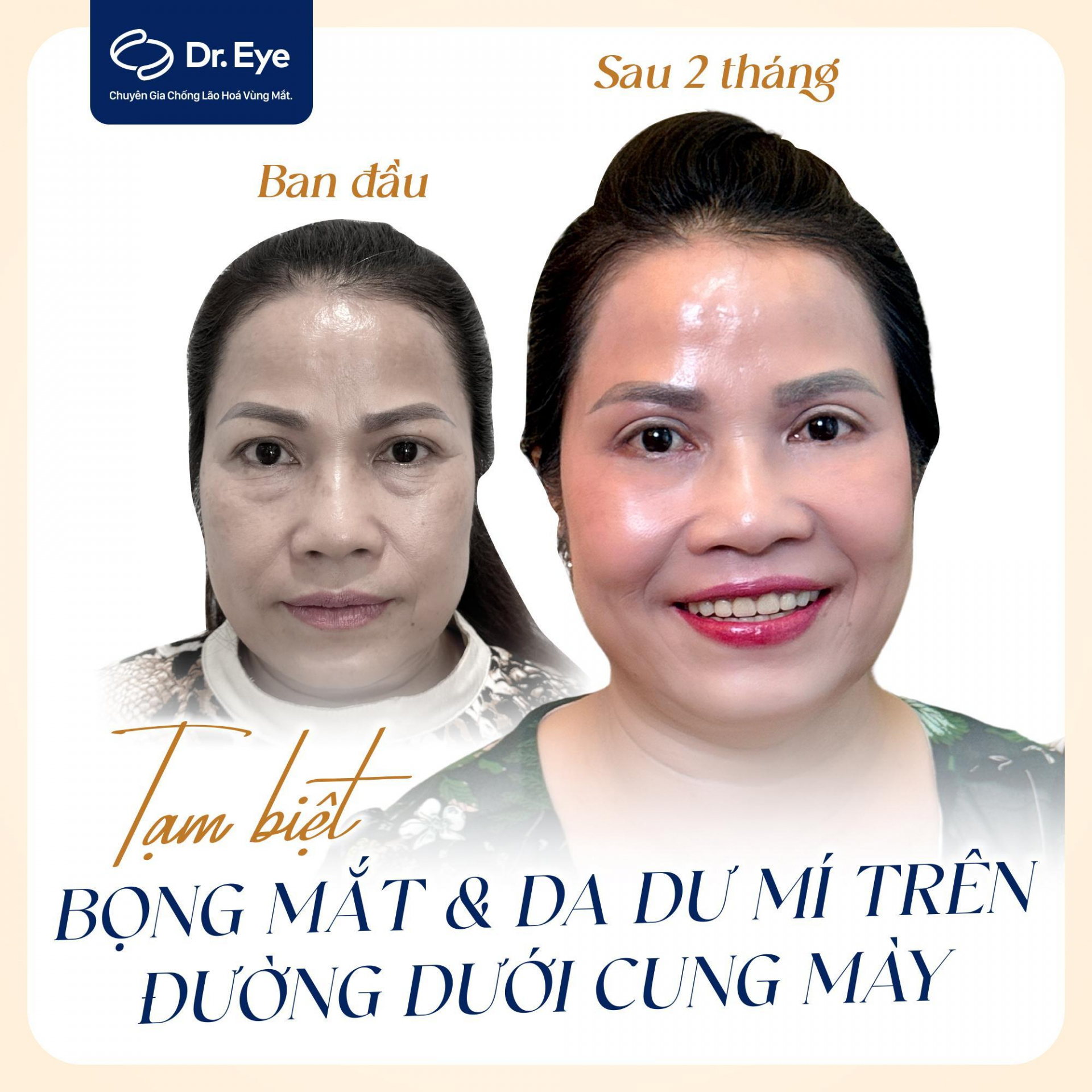 Kết quả thay đổi qua các mốc thời gian sau điều trị trọng mắt tại Dr. Eye.