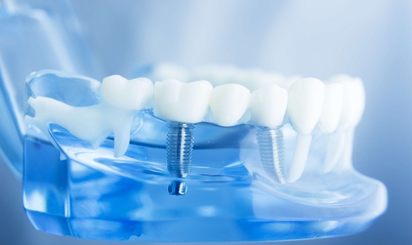 Trung bình trồng implant thời gian lâu nên không phù hợp với người bận rộn

