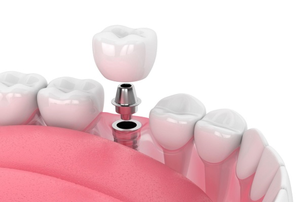 Trồng răng implant đòi hỏi người thực hiện điều trị phải có tay nghề cao

